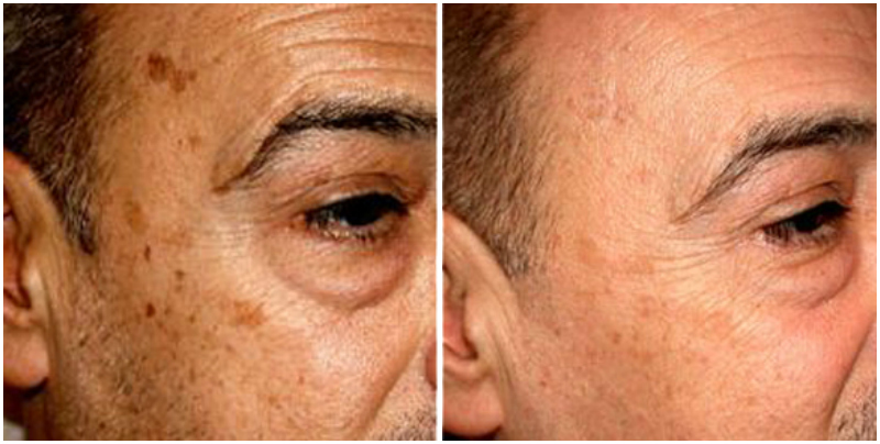 mens skin peel